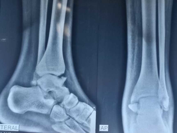 Sai Bhargav Is Struggling With Leg and spinal cord Injury, Help Him