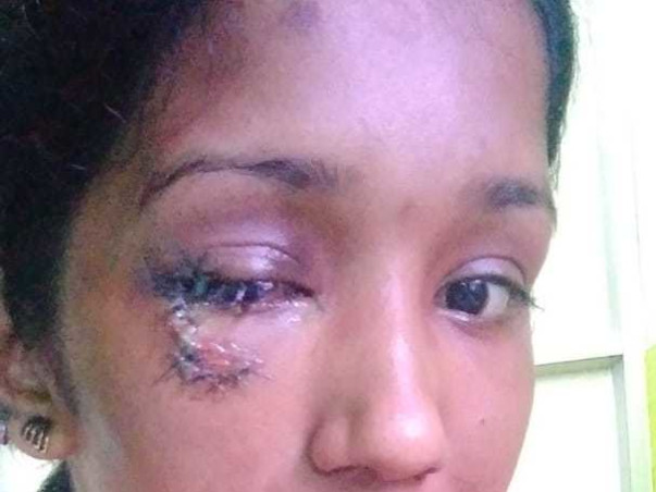 Support Sreemol.R Recover From Chemosis Of Left Eye