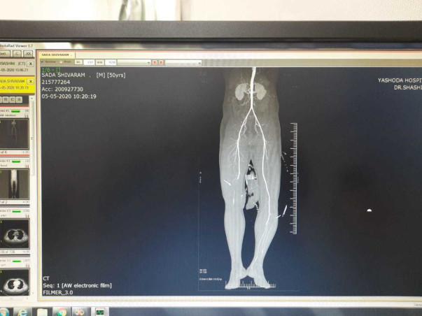 My Father Is Struggling With Leg and Intestine injury, Help Him