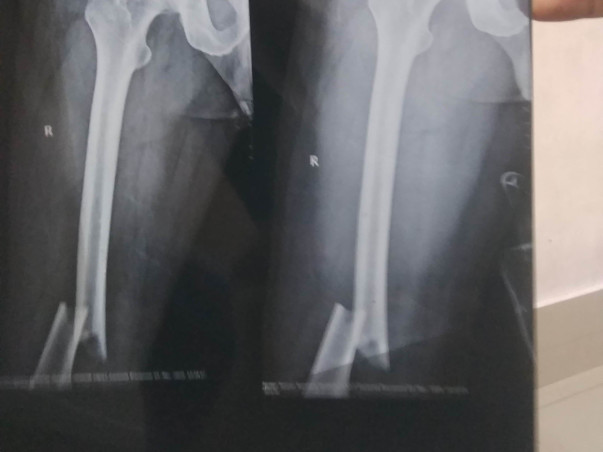 My Father Is Struggling With Leg and Intestine injury, Help Him
