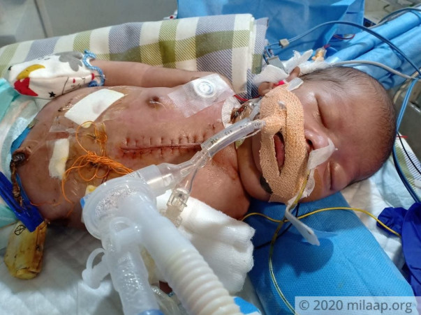 The Large Scar On This Baby’s Chest Is Proof Of His Pain, Needs Help