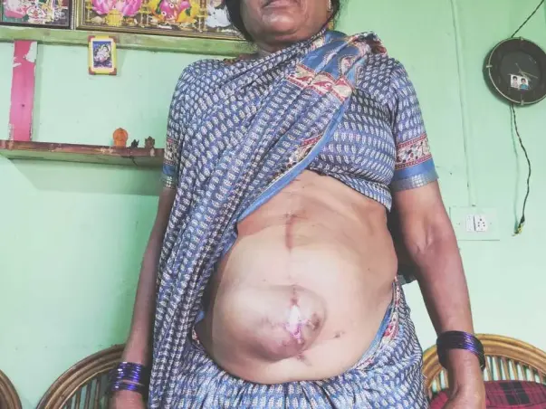 This 60 years old needs your urgent support in fighting Liver Hydatidosis and Incisional Hernia