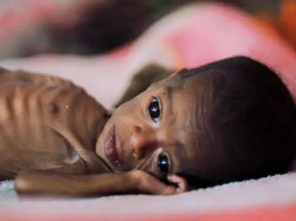 Nutrition for 300 Malnourished children