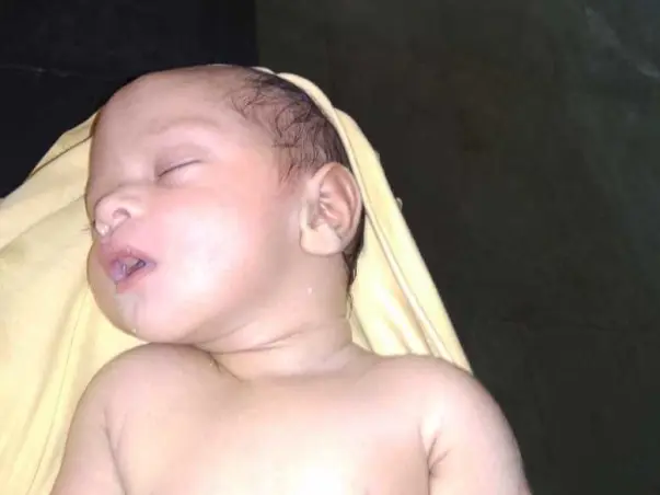 8 days old baby boy suffering from hydrocephalus & meningomyelocele need help for surgery.