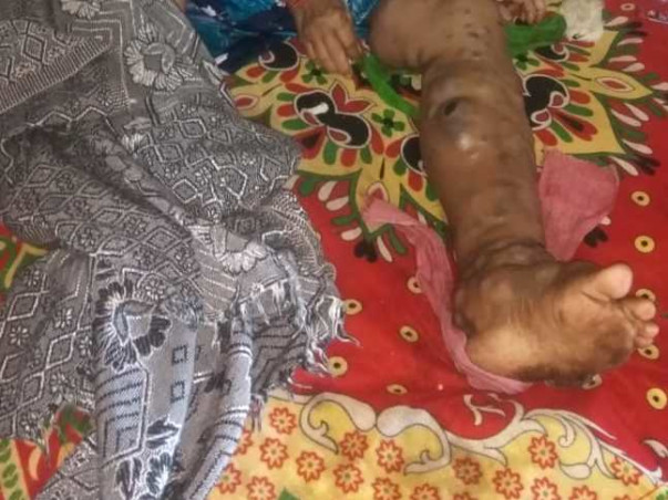 Support terminally ill Afroza live her life with dignity