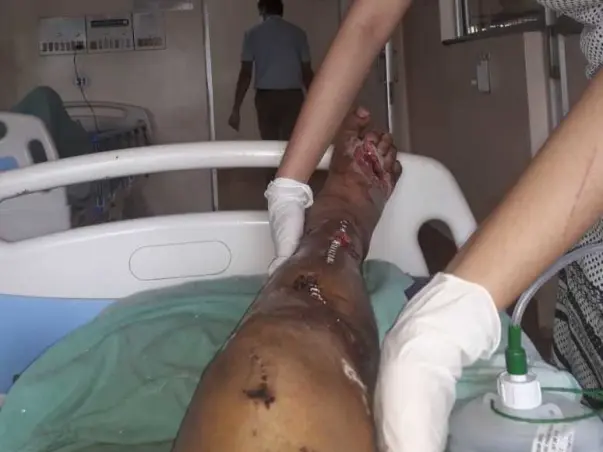My Brother Needs support to save his leg from accident injury(urgent)