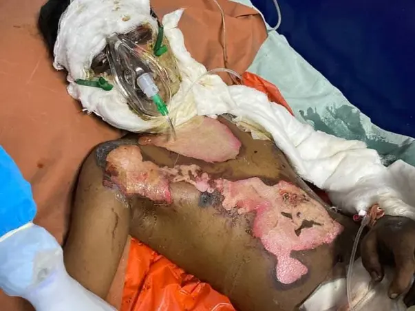 Please Help My Cousin Ajaz Fight Burns