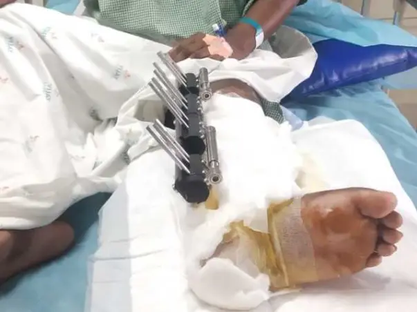 This 26 years old needs your urgent support in fighting Leg surgery