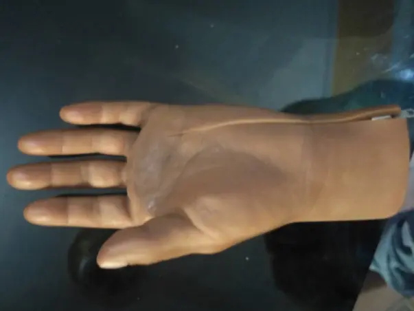 Support Rohit to raise funds for a Prosthetic Hand