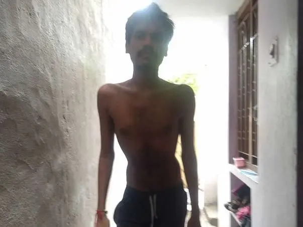 Support Sandeep Recover From Ankylosing spondylitis