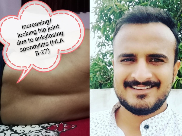 Help me for "treatment of Ankylosing Spondylitis & Reactive Arthritis"