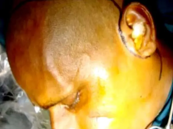 This 40 years old needs your urgent support in fighting Zygomaticomaxillary facture