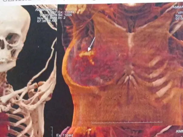 Help My Mother Recover From Breast Cancer