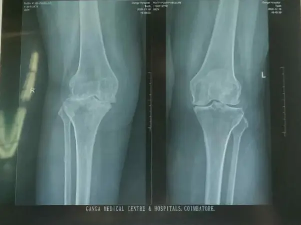 Please Help Me To Walk Again. (Knee Replacement Operation).