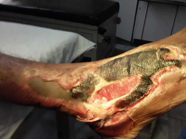 Help Raj In His Leg Treatment