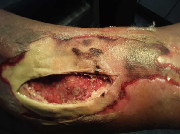 Help Raj In His Leg Treatment