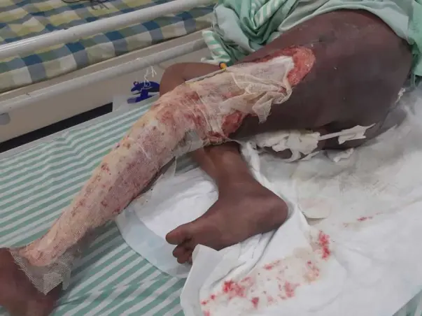 Support Abdul Rahaman Recover From Diabetic Foot With Ulcer