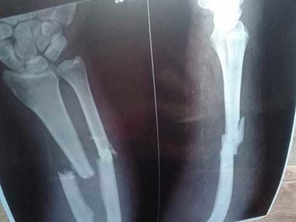 Help Runa : Broken Arms : Domestic Violence