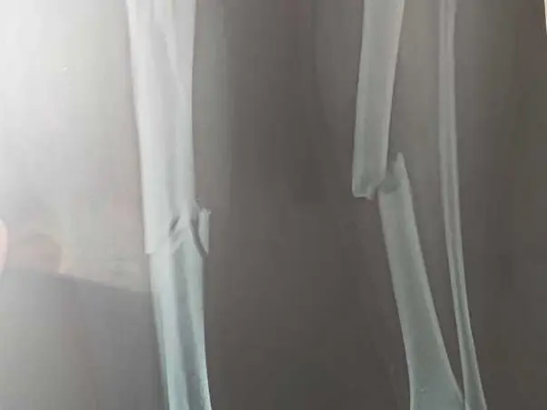 Help Laxminarayana To Get His Leg Back