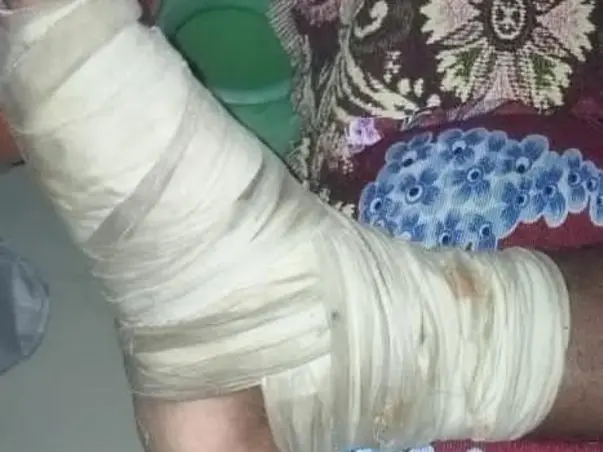Help My Father Shivaiah D Recover From Leg Bone Injury