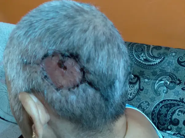 Support Lakshmi Recover From Soft Tissue Sarcoma