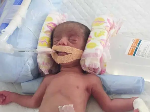 Help My Sons To Recover From Un Developed Lungs