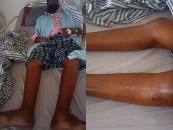 Help My Cousin Recover From Liver Cirrhosis