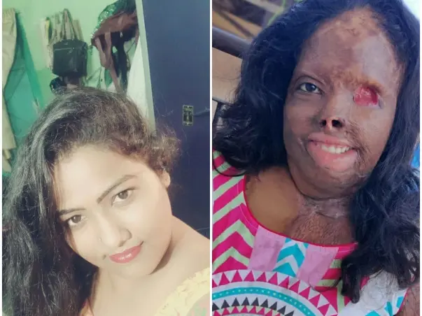 Support Zakira, To Fight On Her Acid Attack