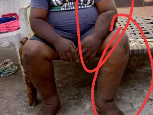 Support M. Karunakar fight/recover from Hemihyperplasia