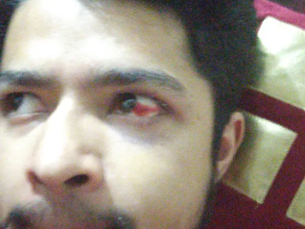 Help for eye medications. Visual effected due to redness in left eye