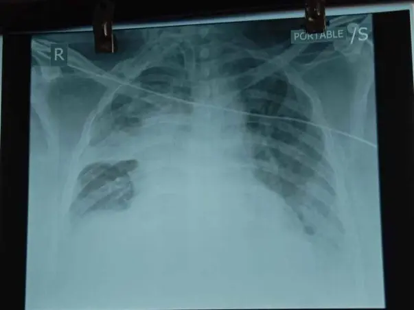 Help My Cousin Sanjay Tamta Is Suffering From Lung Disease