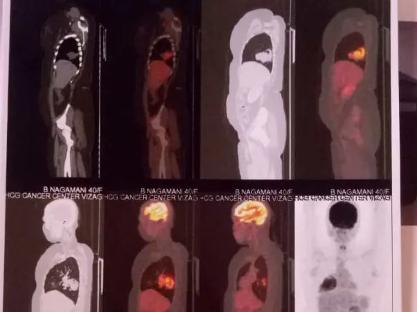 Help My Mother B Nagamani Is Recover From 3rd Stage Lung Cancer