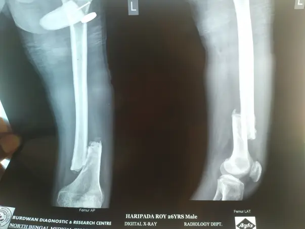 Help Hari Recover From a Fractured Leg