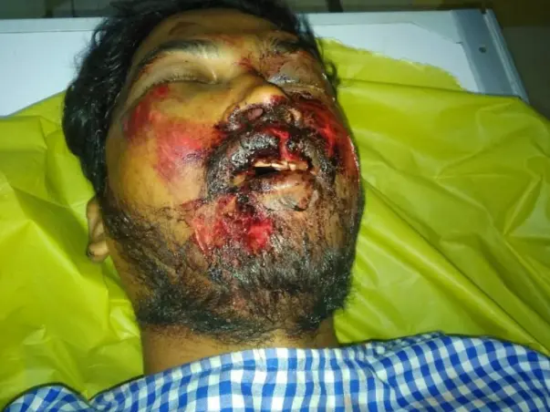 Support Shameer Recover From Multiple Injuries