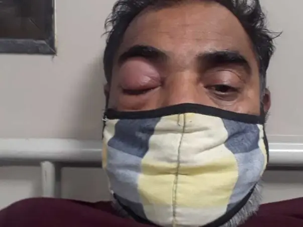 Help My Father Recover From Mucormycosis.