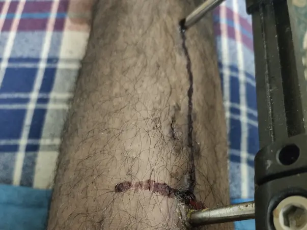 Please Help Me Palash Mondal Recover From Accident Leg Injury