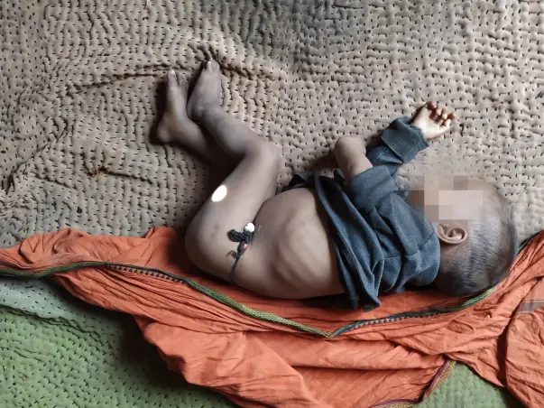 Ration for children with Severe and Acute Malnutrition