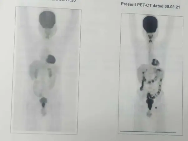 Support My Husband To Recover From  Rectal Cancer operation