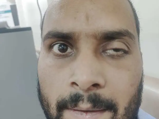 Help Alok To Fight Post COVID-19 Mucormycosis