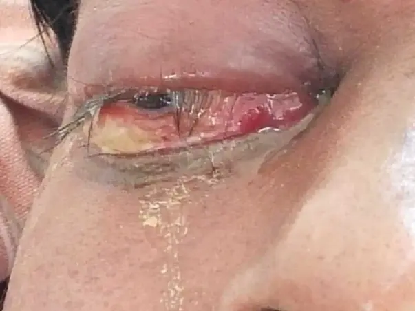 Support Srinivasarao Recover From Black Fungal