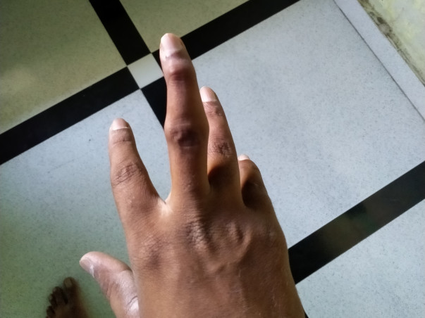 Support Mustakeen Recover From Finger Fracture