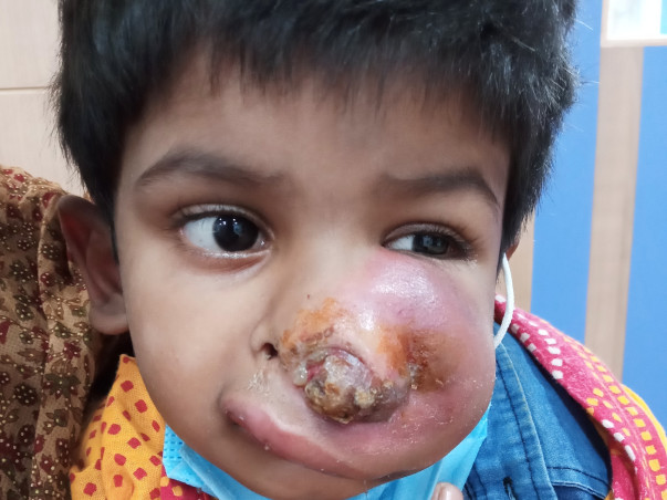 This 4 Years Old Needs Your Urgent Support In Recovering Paranasal Sinus And Nasal Cavity Cancer
