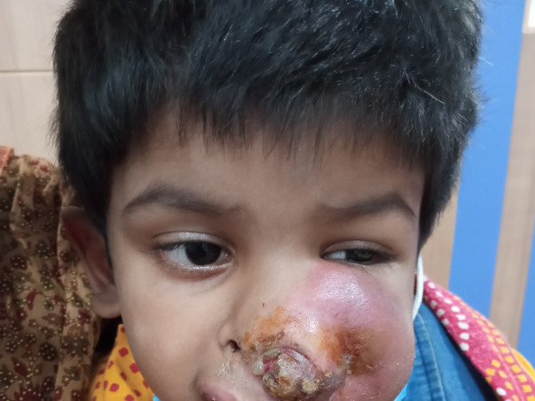 This 4 Years Old Needs Your Urgent Support In Recovering Paranasal Sinus And Nasal Cavity Cancer