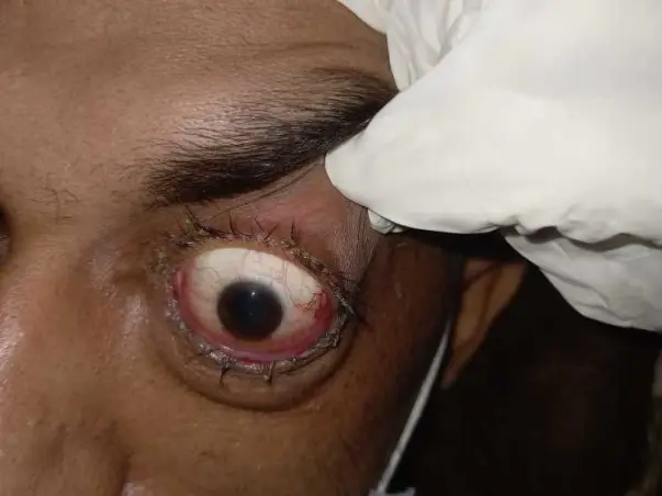 28 Years Old Azad Singh Needs Your Help Recover Fungus Infection Brain, Ears, Eyes,