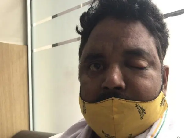Support Giriraj Recover From Black Fungal