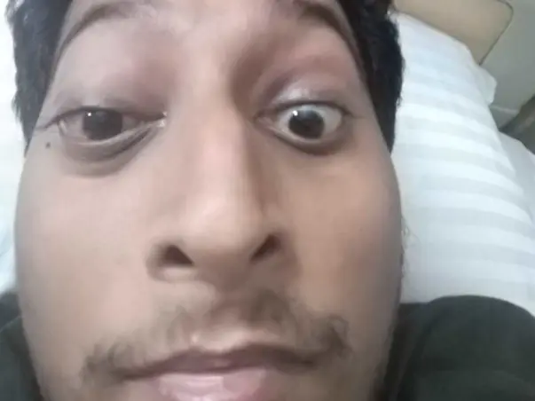 33 years old Shyam Agarwal in ICU, needs your help fight Black fungus
