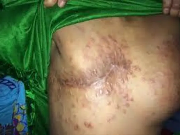 To Get Herceptin For Breast Cancer