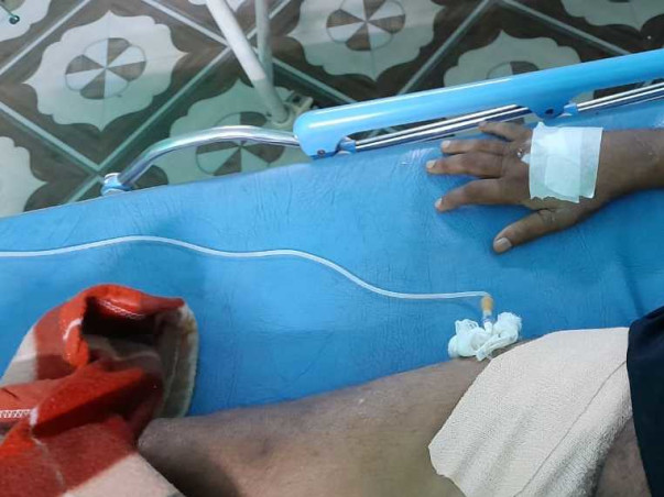 Double kidney transplant,Scan score of 24,90+ infection, on ventilator