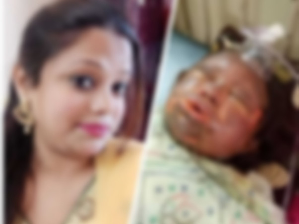 Help Tanu For Her Surgery From Acid Attack