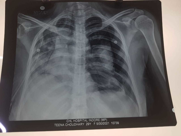 27 years old Tina choudhary( patidar) need help to fight Pneumothorax